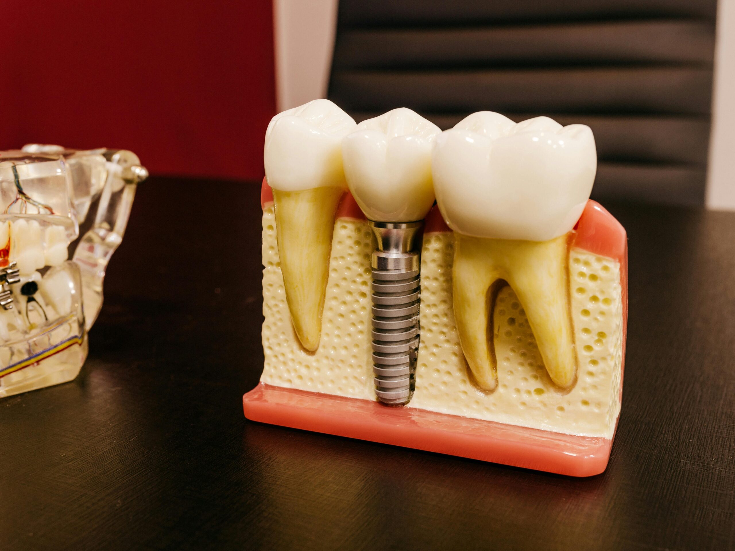 Close-up view of a dental implant model, showcasing the abutment and custom-made prosthetic tooth attached, resembling natural teeth.