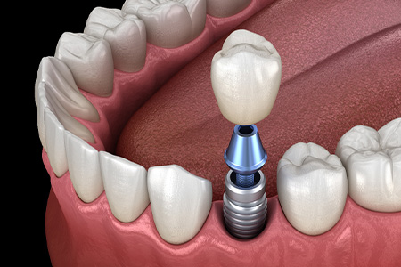 Illustration of crown being attached to a dental implant