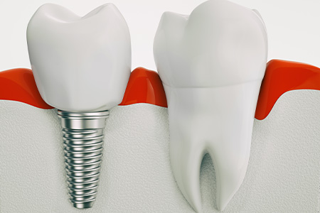 Illustration of dental implant in jaw next to tooth