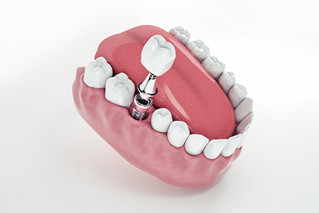 Illustration of crown and abutment being attached to a dental implant