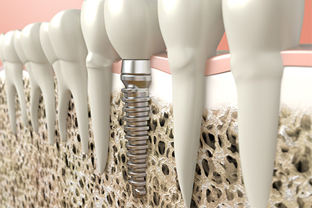 Illustration of dental implant in jawbone