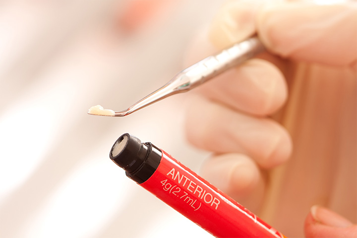 A close-up view of composite resin