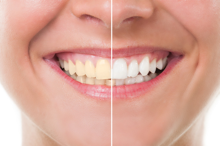 A before-and-after photo demonstrating teeth whitening