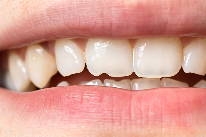 A close-up of a patient with a chipped tooth