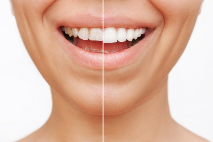 Before and after veneers.