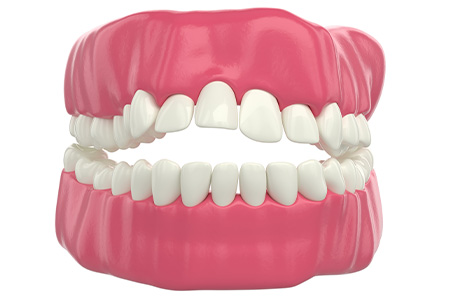 Digital image of an open bite.