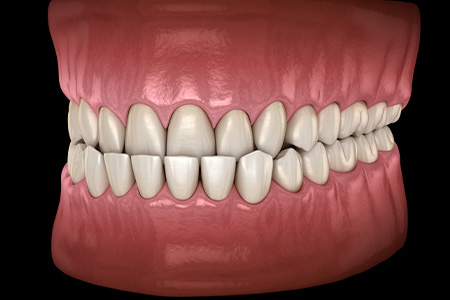 Digital image of an underbite.