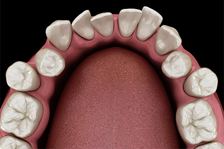 Digital image of crowded or crooked teeth.