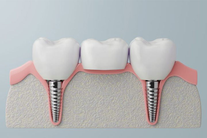 Digital image of traditional dental implant bridge.