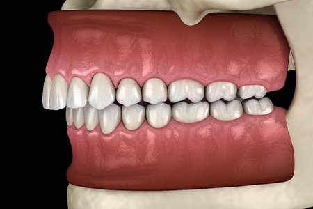 Digital view of an overbite.