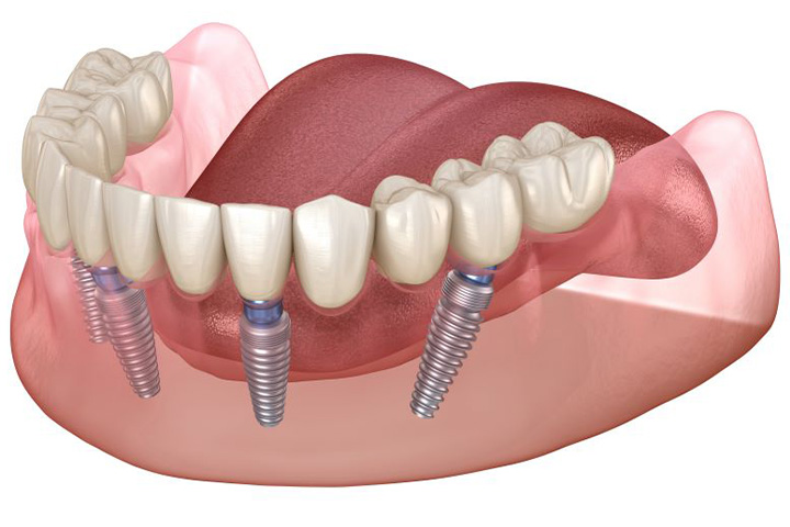 Illustration of All-on-4 dental implants in lower arch.