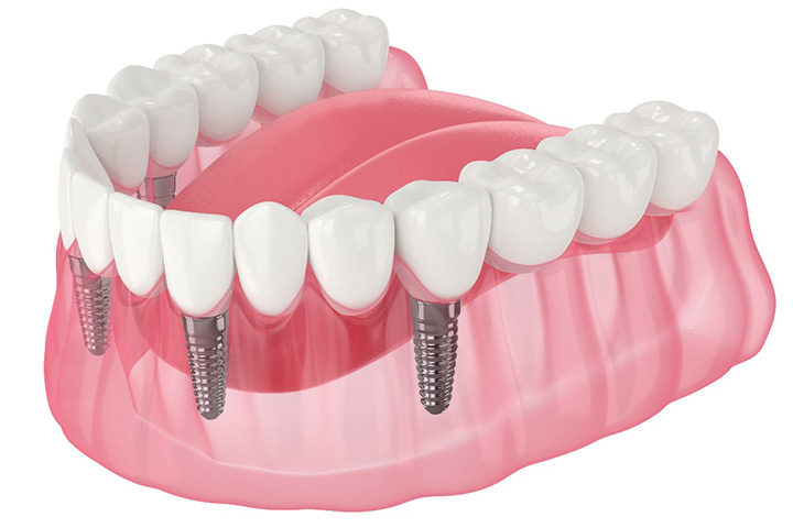 Illustration of an implant denture.