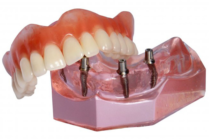 Model of implant dentures.