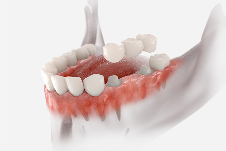 A 3D illustration of a traditional dental bridge.