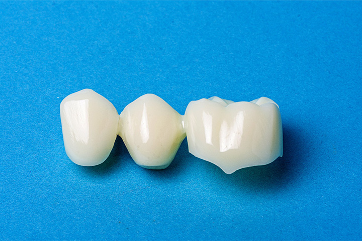 An example of a composite dental bridge.