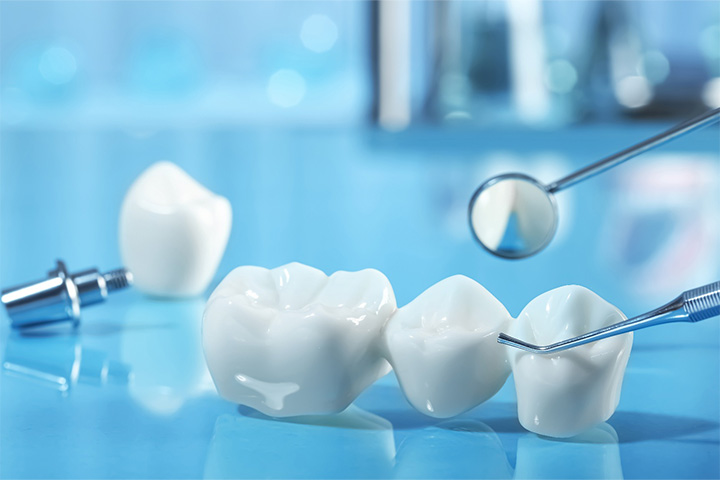 An example of a dental bridge.