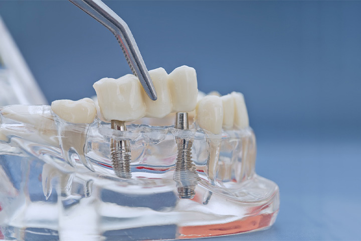 An example of an implant dental bridge.